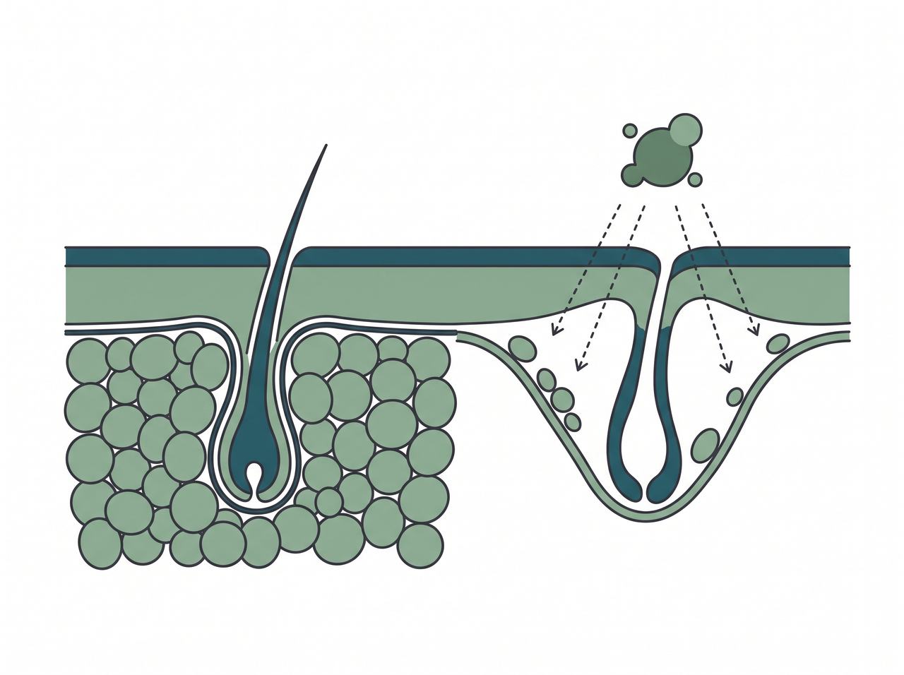 The fat cushion under the scalp collapses and leaves a gap around the follicle