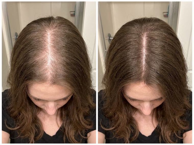 Denise R. — before and after using FST-5