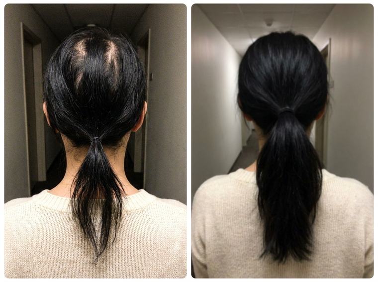 Priya N. — before and after using FST-5
