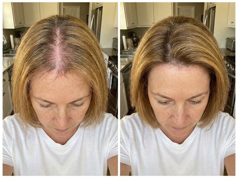 Alison T. — before and after using FST-5